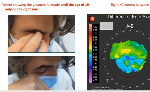 Damien Gatinel MD, PhD - The danger of excessive eye rubbing