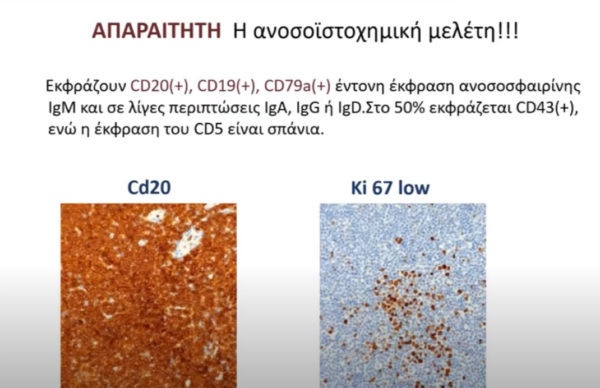 Theodora Dimou MD | Ocular & Adnexal Lymphoma Masterclass (Virtual)