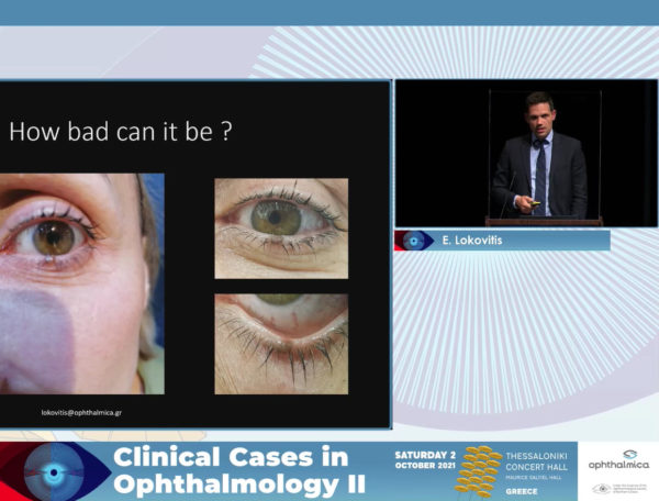 Complex orbital & lacrimal problems: How to deal with them | Clinical Cases II | Ευάγγελος Λοκοβίτης MD, FEBOphth