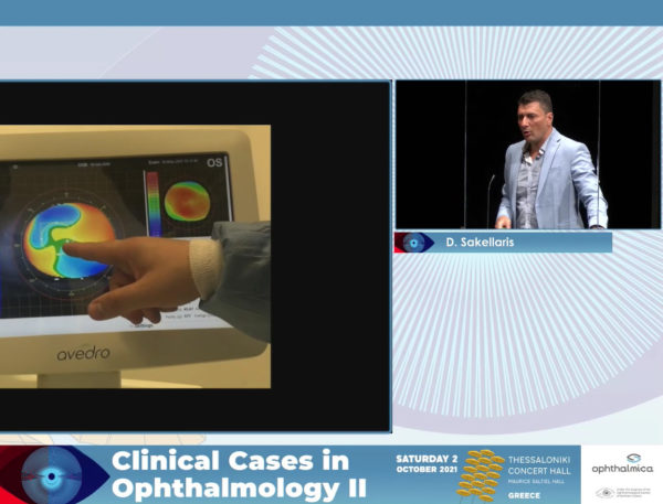 Customized treatments in keratoconus: the way to go | Clinical Cases II | Δημήτριος Σακελλάρης MD