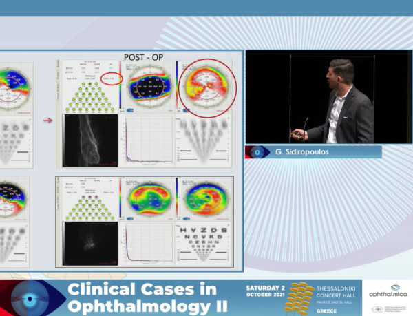 Customized treatments in keratoconus: the way to go | Clinical Cases II | Γεώργιος Σιδηρόπουλος MD, FEBOphth