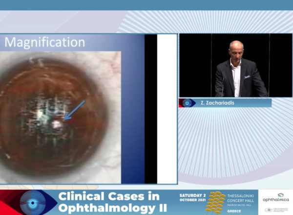 Searching the limits of refractive surgery: the do"s & don"ts | Clinical Cases II | Ζάχος Ζαχαριάδης MD, DO