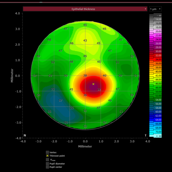 Το Epithelial Thickness Module του συστήματος Heidelberg Anterion στο Ινστιτούτο Ophthalmica