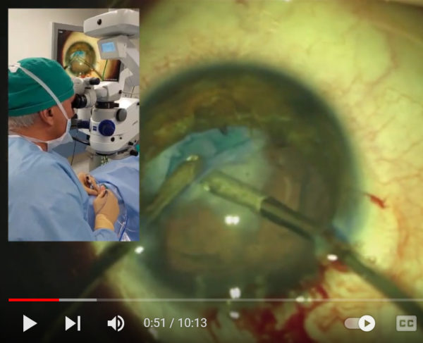 Video of the month | Jan 2023 | Approaching Traumatic Cataract