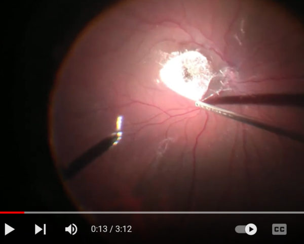 Video of the month | Mar 2023 | Stellate Nonhereditary Idiopathic Foveomacular Retinoschisis (SNIFR)
