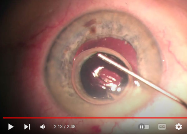 Video of the month | May 2023 | Management of Partial Descemet"s Membrane Tear - Bubble, the Instrument