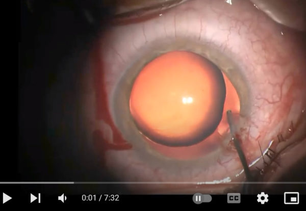 Video of the month | Nov 2023 | Carlevale IOL implantation in a case of Marfan syndrome - related lens subluxation - a best match scenario