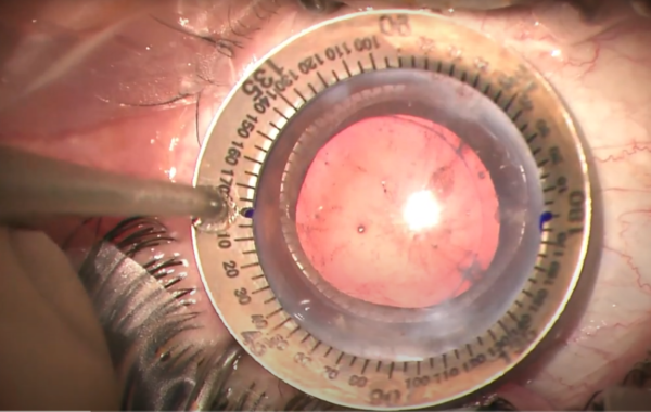 Video of the month | Jan 2024 | enVista® Toric IOL implantation in an eye with a DSAEK graft for Fuchs’ keratopathy - aiming for accuracy