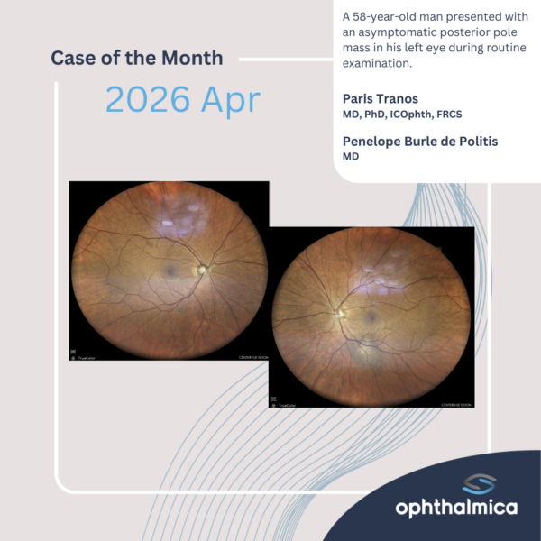 Case of the month | April 2026 | A 58-year-old man presented with an asymptomatic posterior pole mass in his left eye during routine examination
