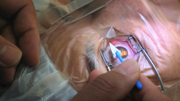 Αδειοδότηση Ινστιτούτο Ophthalmica για Μεταμοσχεύσεις Κερατοειδούς