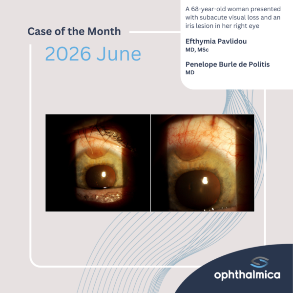 Case of the month | June 2026 | A 68-year-old woman presented with subacute visual loss and an iris lesion in her right eye